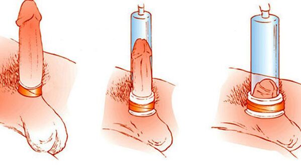 How a penis enlargement vacuum pump works